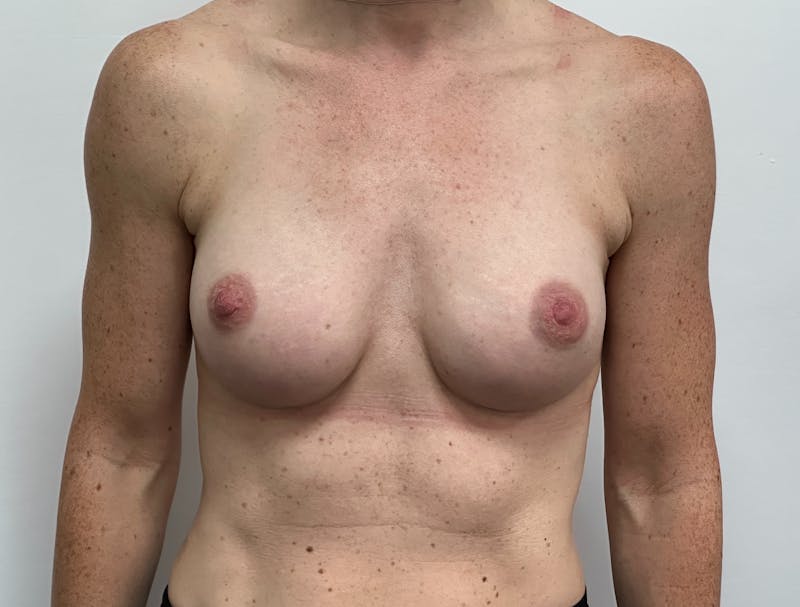 Breast Augmentation Before & After Gallery - Patient 128427 - Image 2