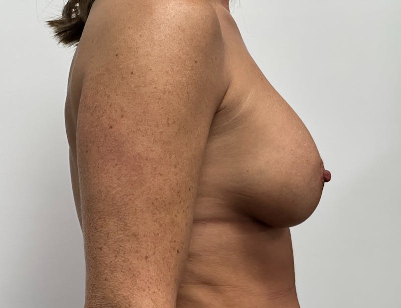 Breast Augmentation Before & After Gallery - Patient 378464 - Image 8