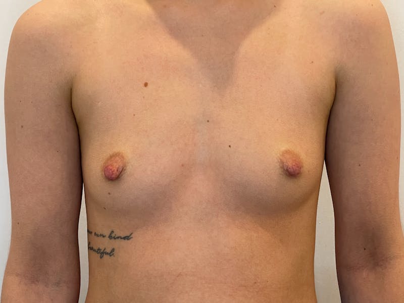 Breast Augmentation Before & After Gallery - Patient 170238 - Image 1