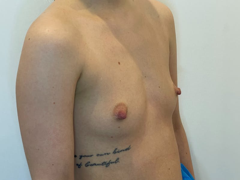 Breast Augmentation Before & After Gallery - Patient 170238 - Image 3
