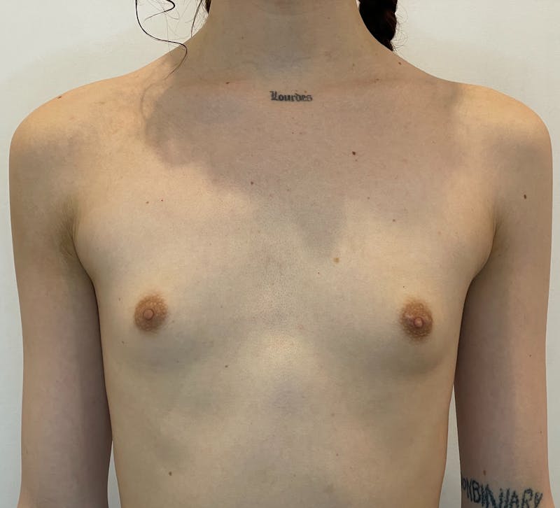 Breast Augmentation Before & After Gallery - Patient 135104 - Image 1