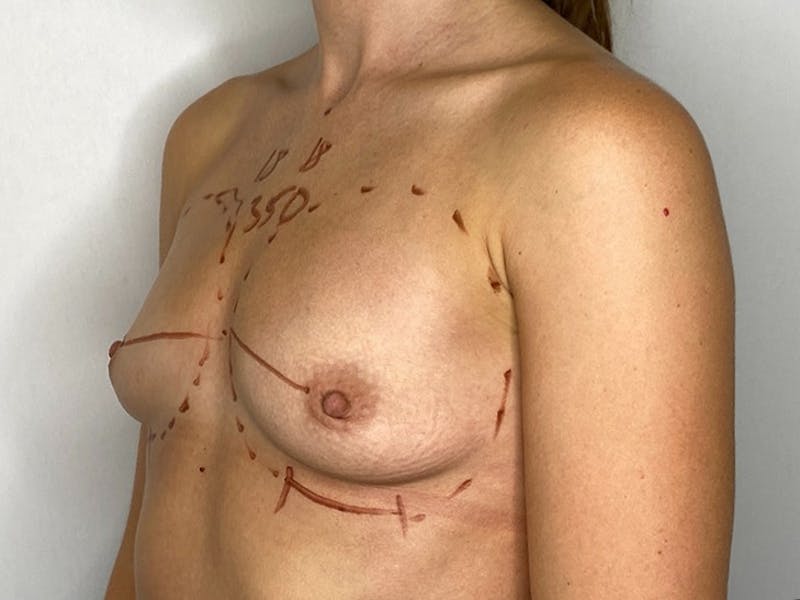 Breast Augmentation Before & After Gallery - Patient 143746525 - Image 1