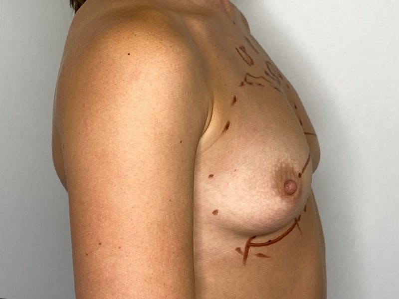 Breast Augmentation Before & After Gallery - Patient 143746525 - Image 3