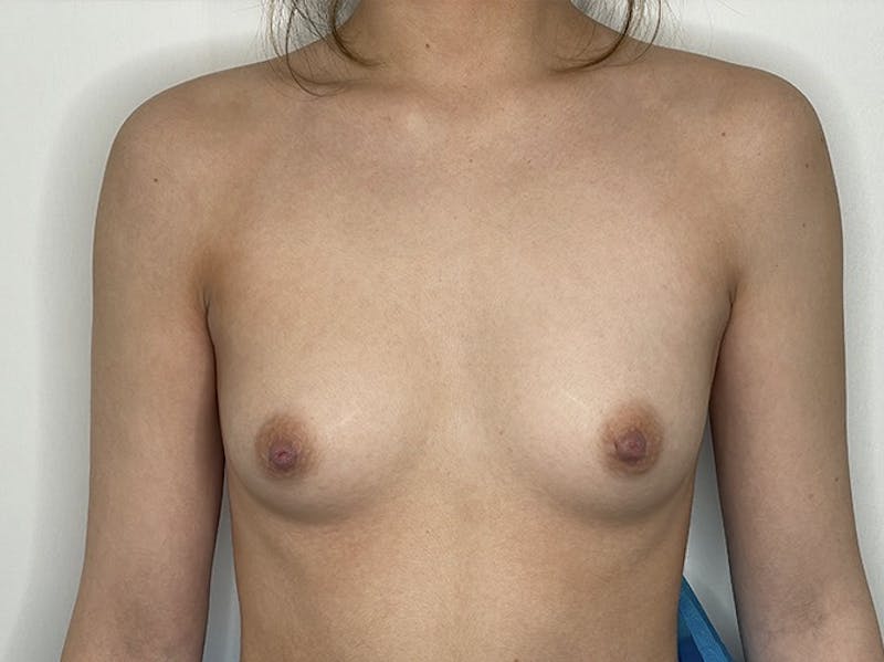 Breast Augmentation Before & After Gallery - Patient 121144513 - Image 1