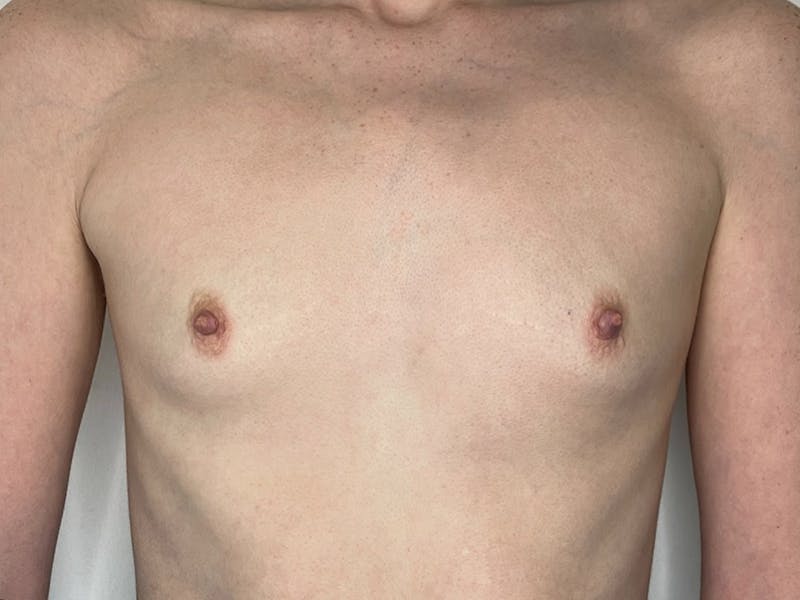 Breast Augmentation Before & After Gallery - Patient 106999867 - Image 1
