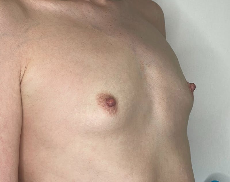 Breast Augmentation Before & After Gallery - Patient 106999867 - Image 3