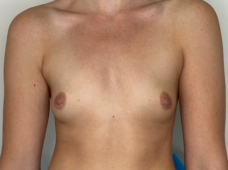 Breast Augmentation Before & After Gallery - Patient 106999878 - Image 1