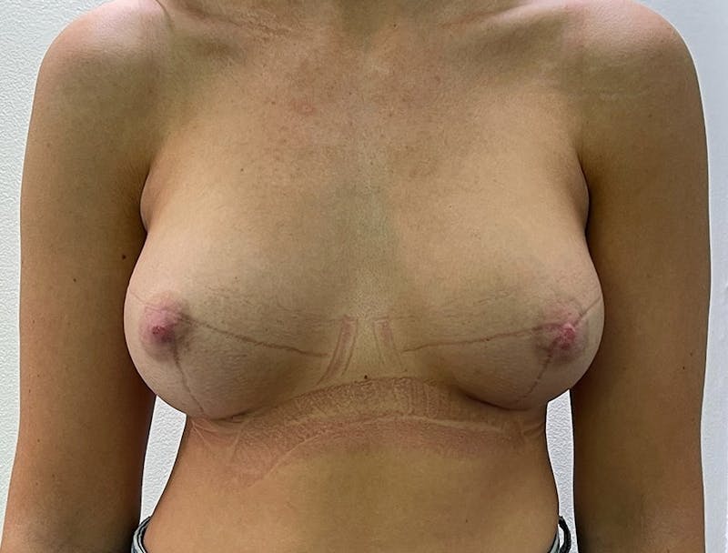 Breast Augmentation Before & After Gallery - Patient 106999878 - Image 2