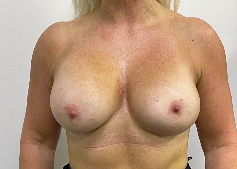 Breast Augmentation Before & After Gallery - Patient 101412193 - Image 2