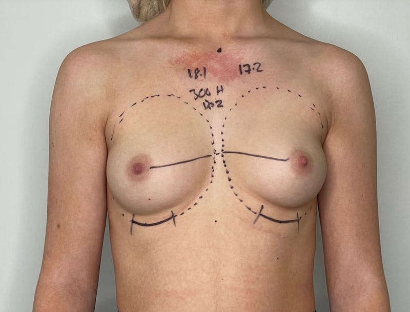 Breast Augmentation Before & After Gallery - Patient 101412195 - Image 1