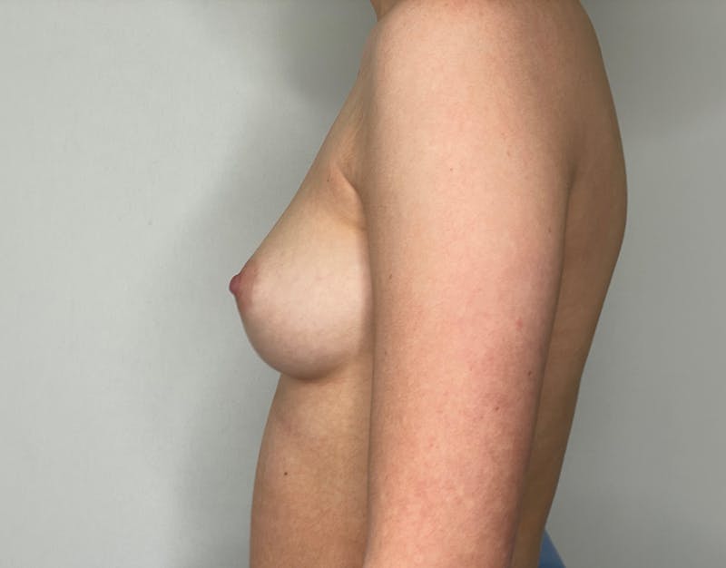 Breast Augmentation Before & After Gallery - Patient 101412195 - Image 5