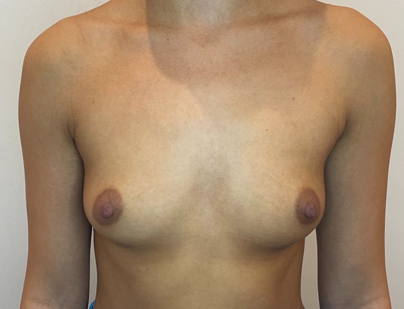 Breast B&A