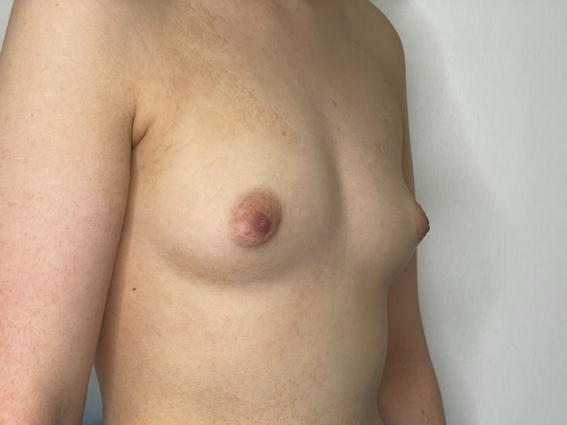 Breast Augmentation Before & After Gallery - Patient 101412258 - Image 1