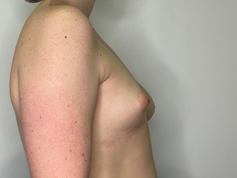 Breast Augmentation Before & After Gallery - Patient 101412264 - Image 1