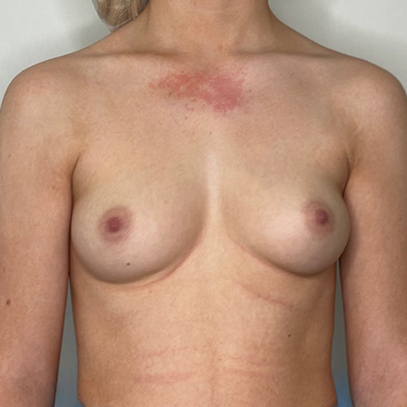 Breast Augmentation Before & After Gallery - Patient 93812192 - Image 1