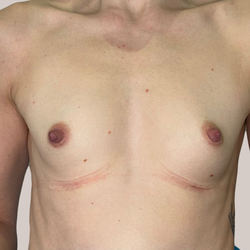 Breast Augmentation Before & After Gallery - Patient 93812194 - Image 1