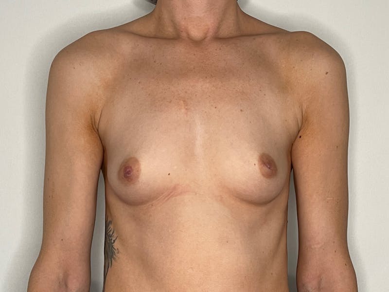 Breast Augmentation Before & After Gallery - Patient 101412261 - Image 1