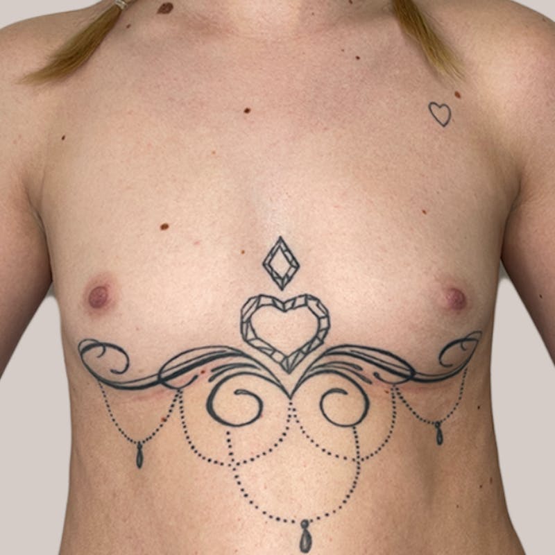 Breast Augmentation Before & After Gallery - Patient 93812214 - Image 1