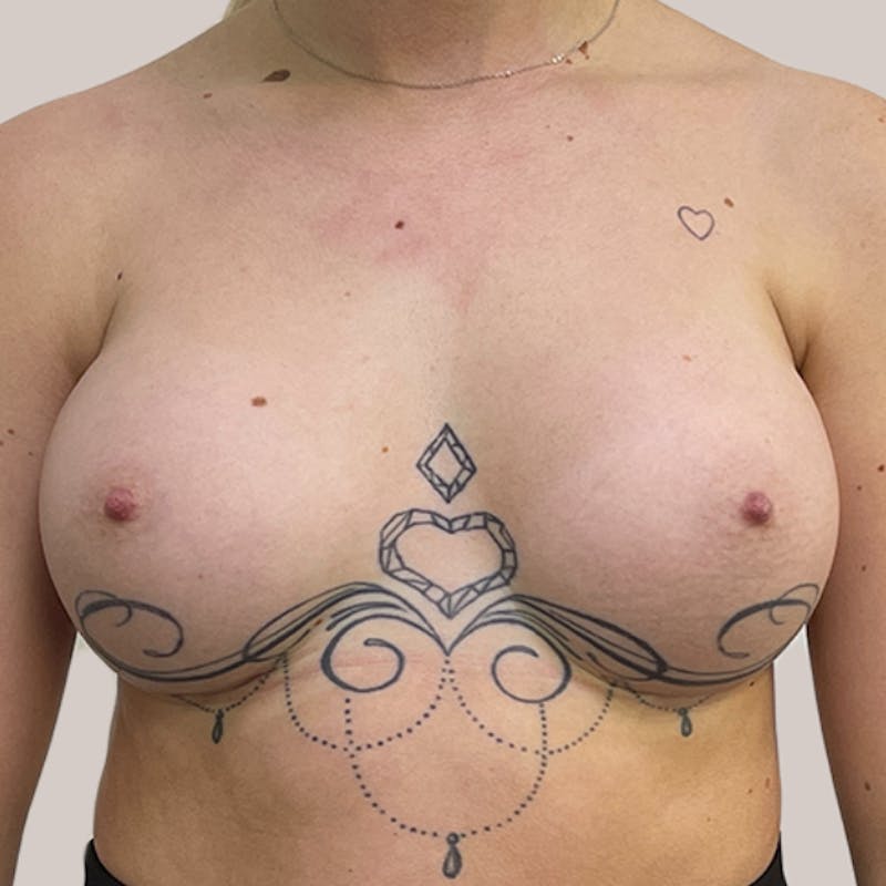 Breast Augmentation Before & After Gallery - Patient 93812214 - Image 2