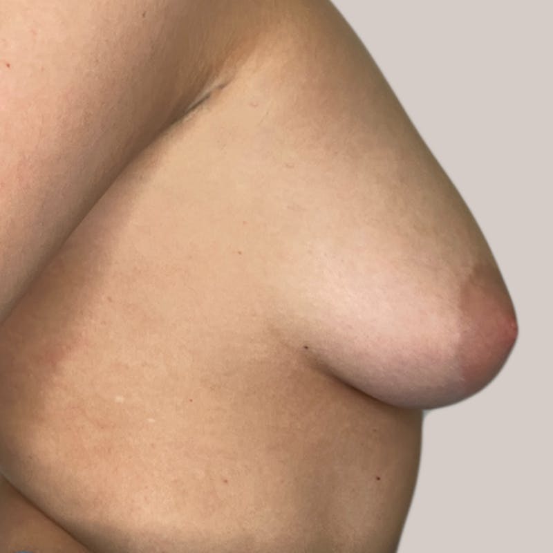 Breast Augmentation Before & After Gallery - Patient 93812215 - Image 1