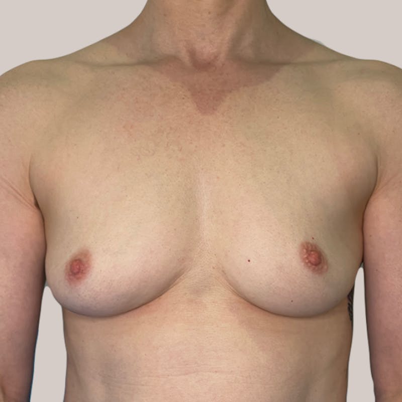 Breast Augmentation Before & After Gallery - Patient 93812209 - Image 1