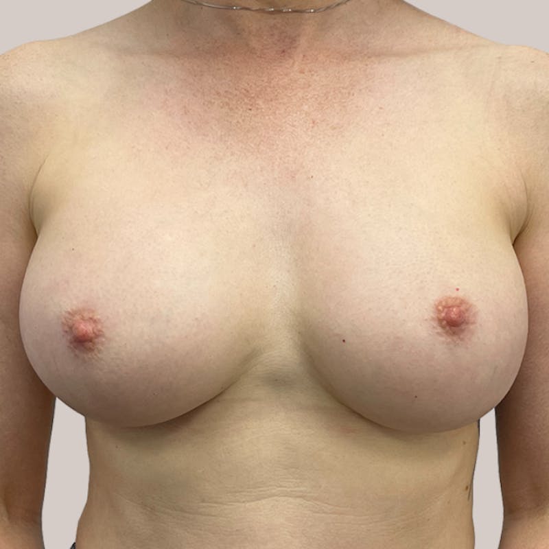 Breast Augmentation Before & After Gallery - Patient 93812209 - Image 2