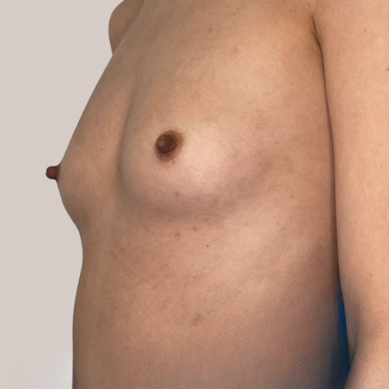 Breast Augmentation Before & After Gallery - Patient 93812217 - Image 1