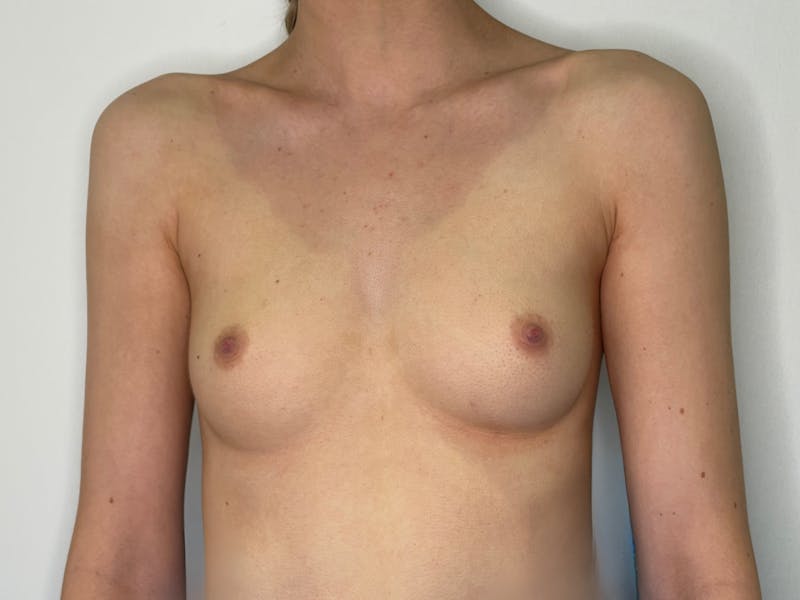 Breast Augmentation Before & After Gallery - Patient 101412318 - Image 1