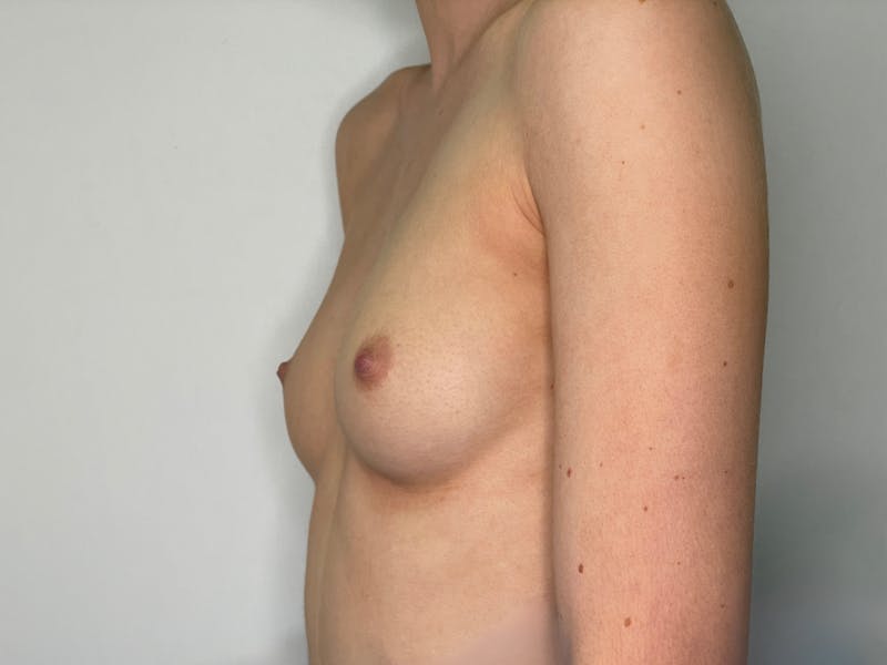 Breast Augmentation Before & After Gallery - Patient 101412318 - Image 3