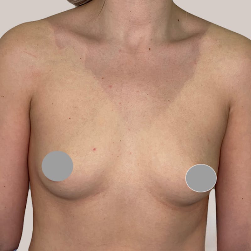 Breast Augmentation Before & After Gallery - Patient 93812210 - Image 1