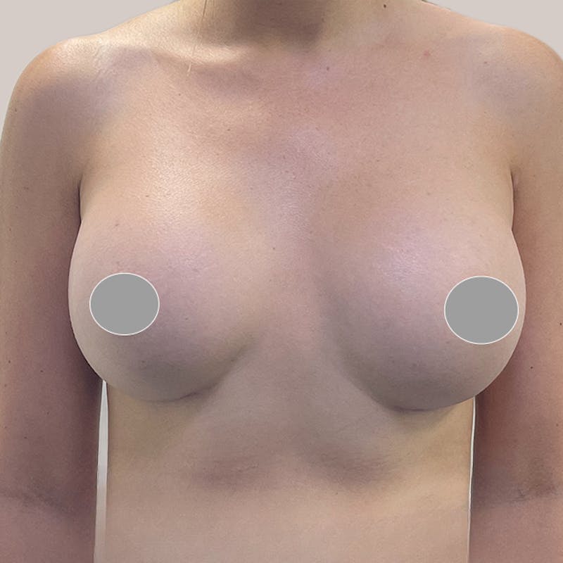Breast Augmentation Before & After Gallery - Patient 93812210 - Image 2