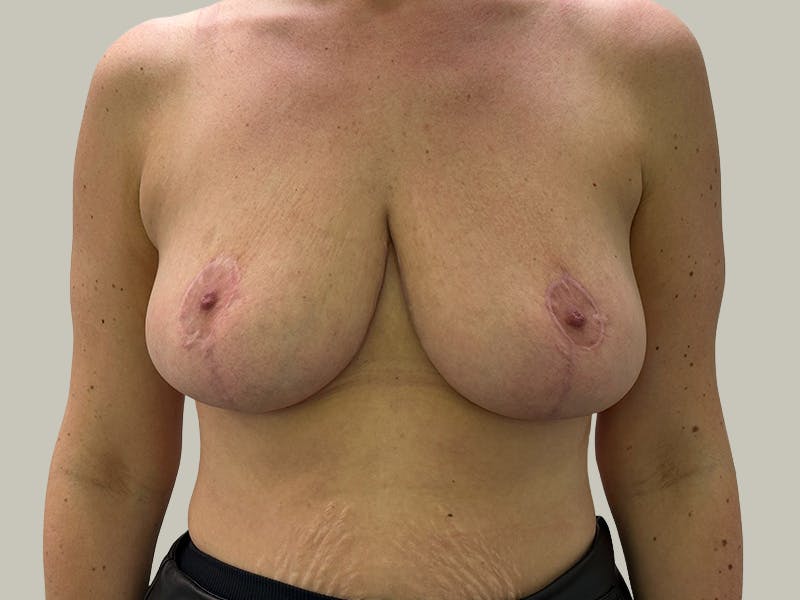 Breast Reduction  Before & After Gallery - Patient 148337620 - Image 2