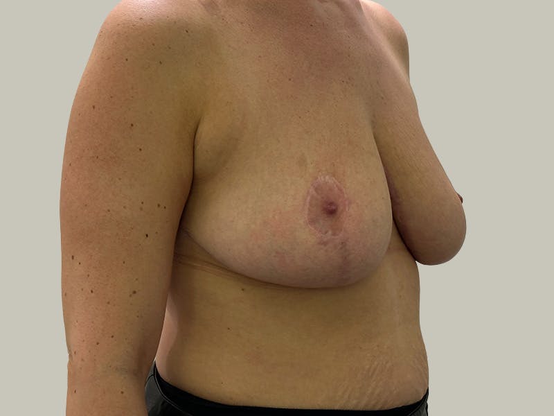 Breast Reduction  Before & After Gallery - Patient 148337620 - Image 4