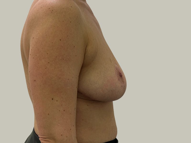 Breast Reduction  Before & After Gallery - Patient 148337620 - Image 6