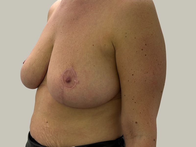 Breast Reduction  Before & After Gallery - Patient 148337620 - Image 8