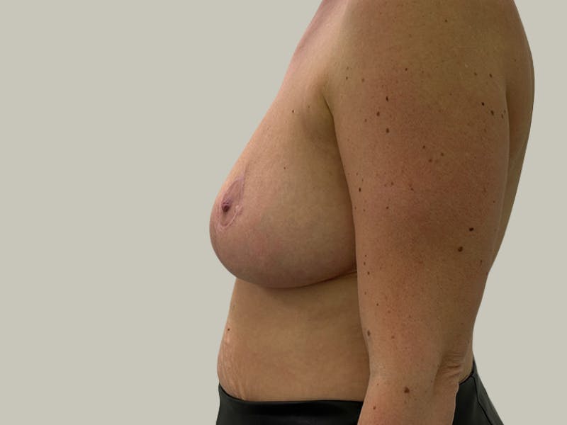Breast Reduction  Before & After Gallery - Patient 148337620 - Image 10