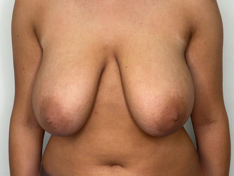 Breast Reduction  Before & After Gallery - Patient 115307210 - Image 1