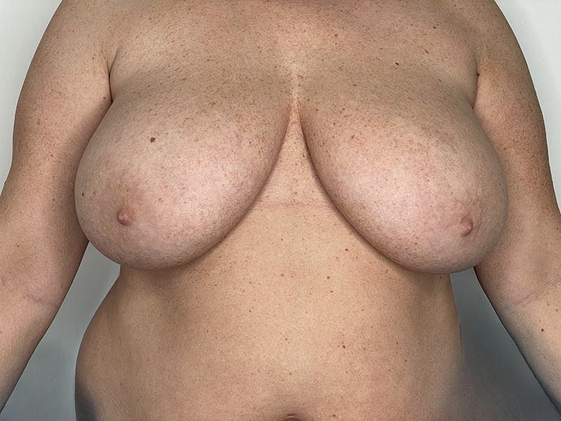 Breast Reduction  Before & After Gallery - Patient 121144526 - Image 1
