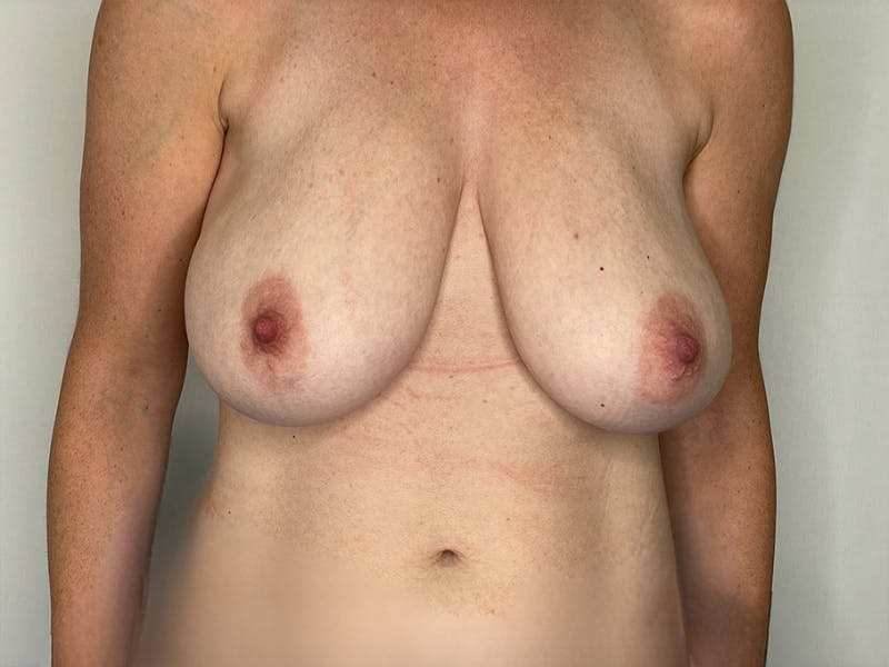 Breast Reduction  Before & After Gallery - Patient 106999201 - Image 1