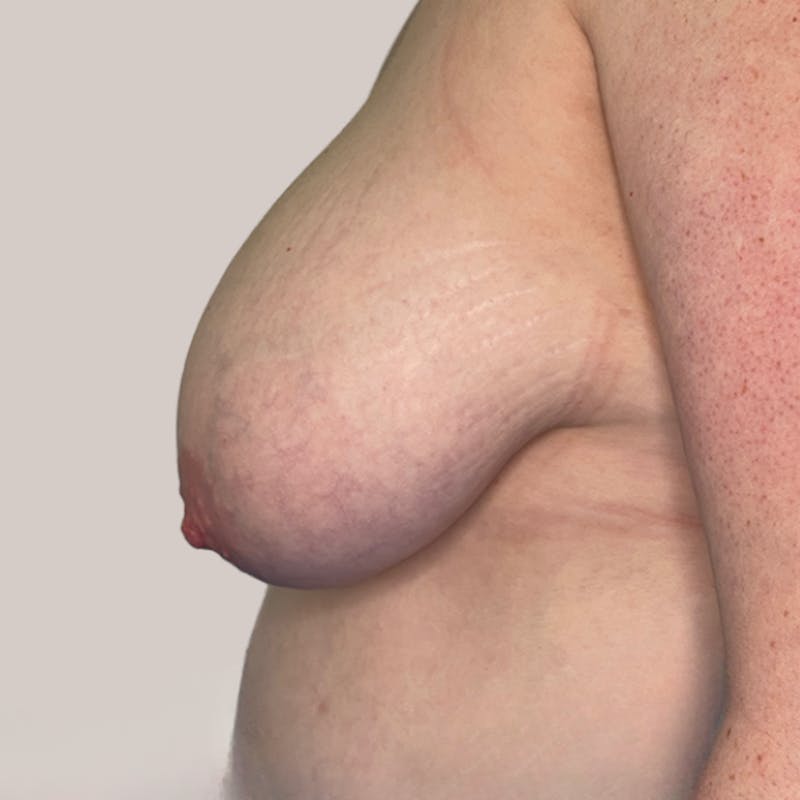 Breast Reduction  Before & After Gallery - Patient 93812250 - Image 1