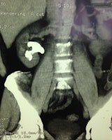 Cirugía Cirugía renal percutanea o nefrolitotomia