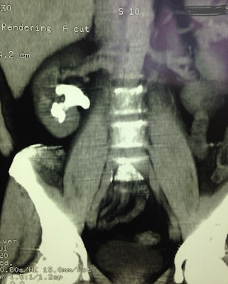 Cirugía Cirugía renal percutanea o nefrolitotomia