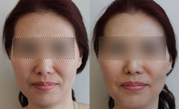 Liquid Facelift
