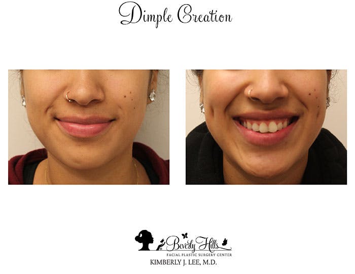 Dimple Creation Before & After Gallery - Patient 85939967 - Image 1