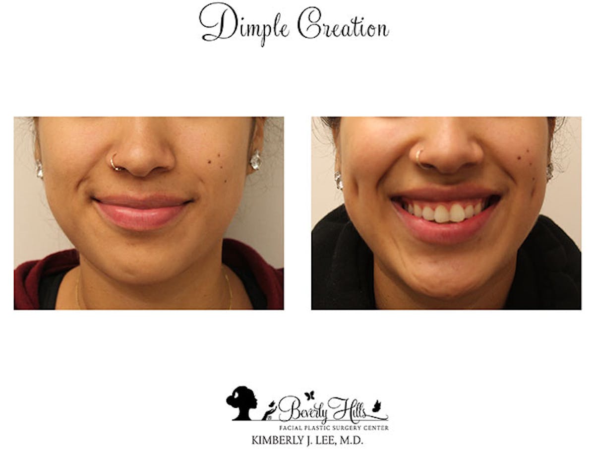 Dimple Creation Before & After Gallery - Patient 85939967 - Image 1