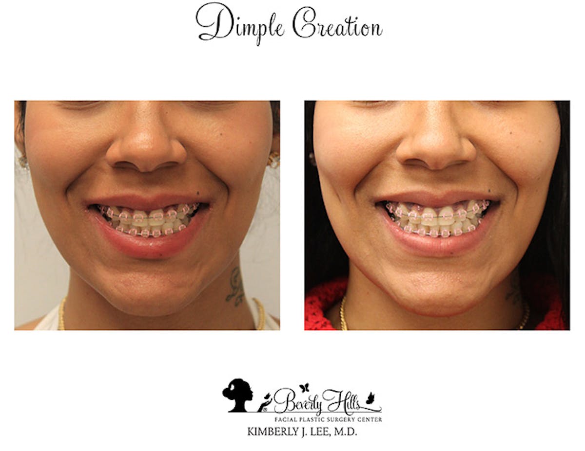 Dimple Creation Before & After Gallery - Patient 85939968 - Image 3