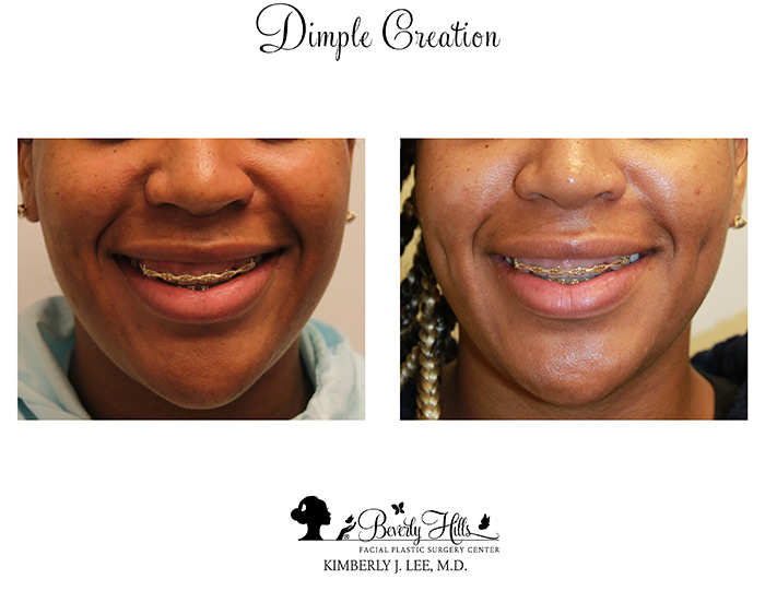 Patient 85939971 | Dimple Creation Before & After Photos | Dr