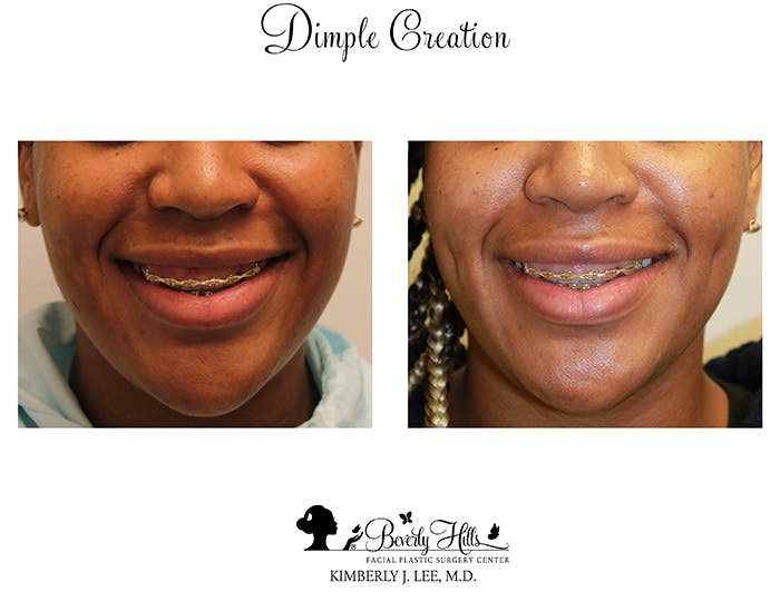 Dimple Creation Before & After Gallery - Patient 85939971 - Image 5