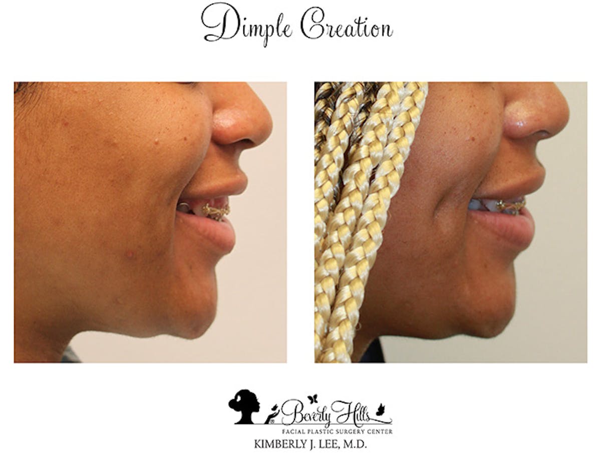 Dimple Creation Before & After Gallery - Patient 85939971 - Image 3