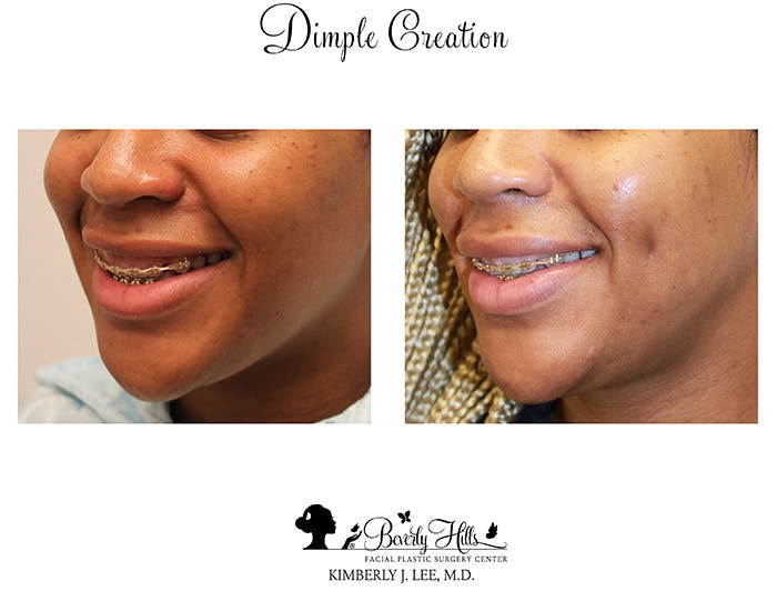 Dimple Creation Before & After Gallery - Patient 85939971 - Image 1